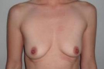 Breast Augmentation Case 26 Before