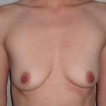 Breast Augmentation Case 26 Before