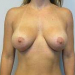 Breast Augmentation Case 27 After