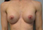 Breast Augmentation Case 28 After