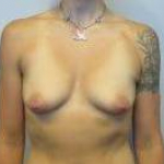 Breast Augmentation Case 29 Before
