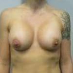 Breast Augmentation Case 29 After