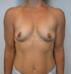 Breast Augmentation Case 33 Before