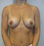 Breast Augmentation Case 33 After