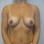 Breast Augmentation Case 33 After