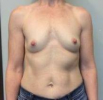 Breast Augmentation Case 34 Before