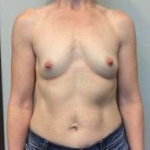 Breast Augmentation Case 34 Before