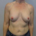Breast Augmentation Case 34 After