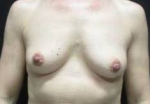 Breast Augmentation Case 35 Before
