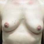 Breast Augmentation Case 35 Before