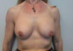 Breast Augmentation Case 35 After