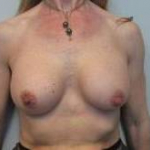 Breast Augmentation Case 35 After