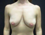 Breast Augmentation Case 36 Before