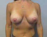 Breast Augmentation Case 36 After