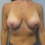 Breast Augmentation Case 36 After