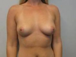 Breast Augmentation Case 37 Before