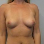 Breast Augmentation Case 37 Before