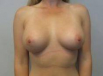 Breast Augmentation Case 37 After