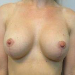 Breast Augmentation Case 39 After