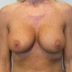 Breast Augmentation Case 40 Before