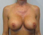 Breast Augmentation Case 40 After