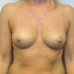 Breast Augmentation Case 41 Before