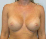 Breast Augmentation Case 41 After