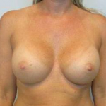 Breast Augmentation Case 41 After