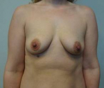 Breast Augmentation Case 42 Before
