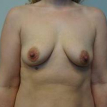 Breast Augmentation Case 42 Before