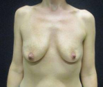 Breast Augmentation Case 43 Before