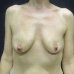 Breast Augmentation Case 43 Before