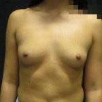 Breast Augmentation Case 44 Before
