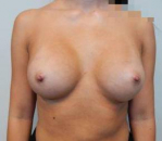 Breast Augmentation Case 44 After