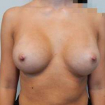 Breast Augmentation Case 44 After
