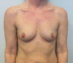 Breast Augmentation Case 45 Before