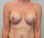 Breast Augmentation Case 45 After