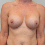 Breast Augmentation Case 45 After