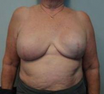 Breast Reconstruction Case 3 After