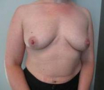 Breast Reconstruction Case 4 Before