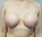 Breast Reconstruction Case 4 After