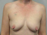 Breast Reconstruction Case 5 Before
