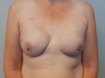 Breast Reconstruction Case 5 After