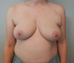 Breast Reconstruction Case 7 Before