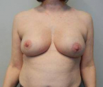 Breast Reconstruction Case 7 After