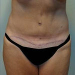 Abdominoplasty Case 8 After