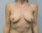 Breast Reconstruction Case 9 Before