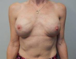 Breast Reconstruction Case 9 After