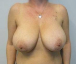 Breast Reconstruction Case 10 Before