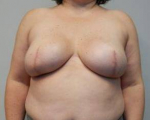 Breast Reconstruction Case 11 After